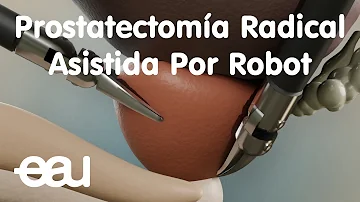 ¿Es mejor la radiación o la prostatectomía radical?