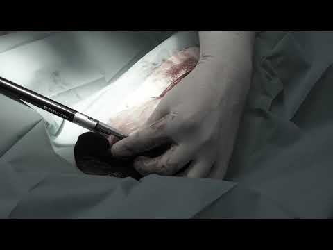 Extracción de bazo en perro (imágenes sensibles) hqdefault