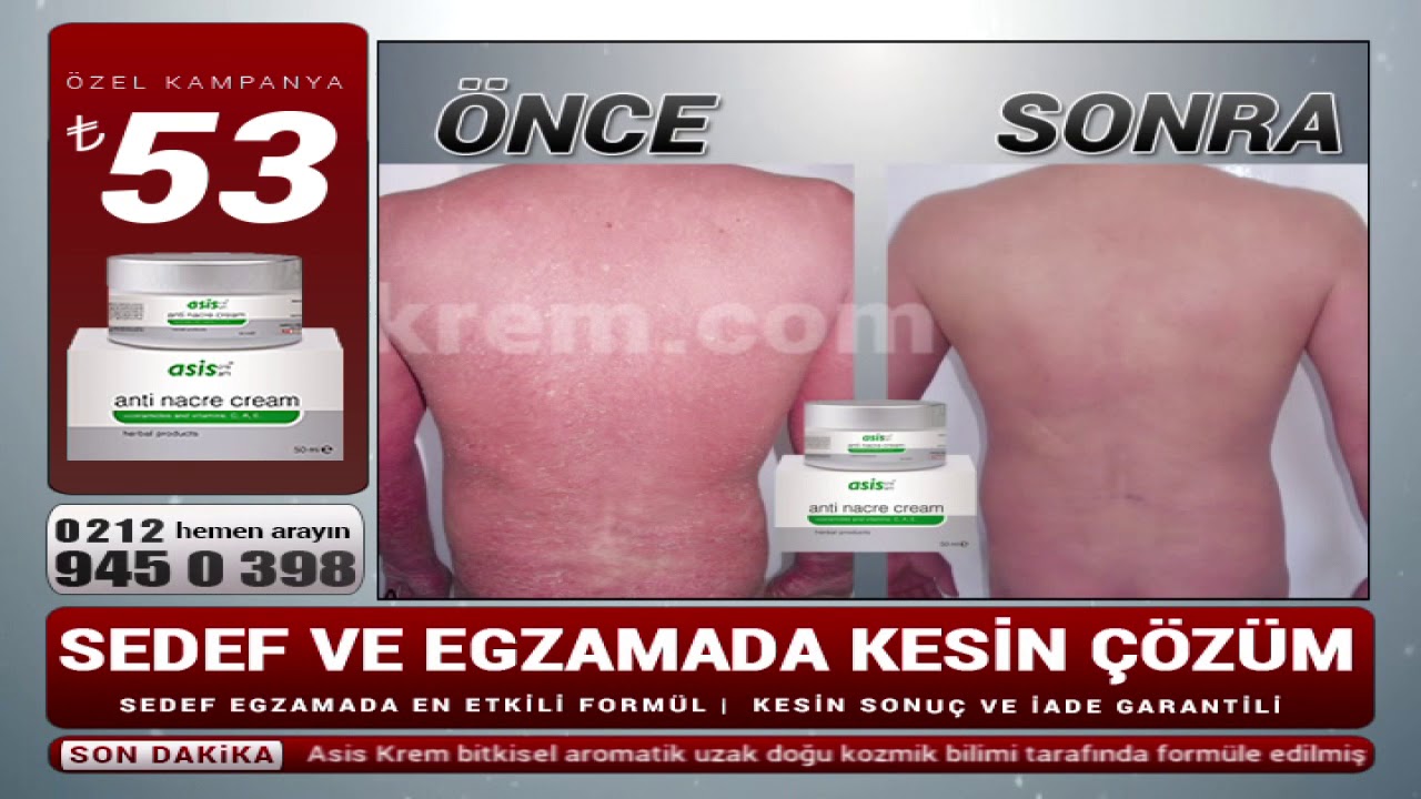 Doğal Sedef ve Egzama Kremi Doğal Sedef ve Egzama Kremi