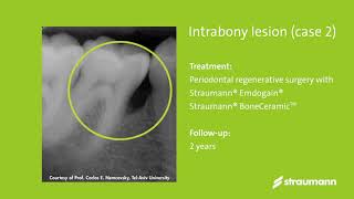 Clinical use of Straumann® BoneCeramic Dr. Nemcovsky