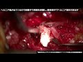 動画3　椎間板ヘルニア摘出術（LOVE法）