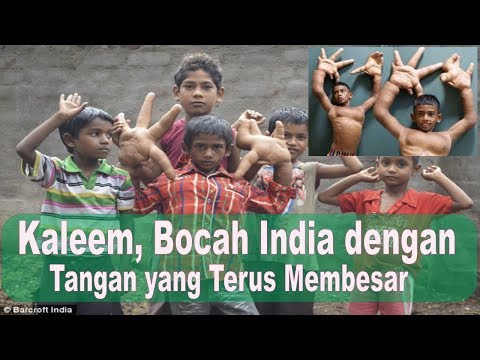 Video: Seorang Anak Laki-laki India Dengan Kaki Yang Besar Membuat Bingung Para Dokter - Pandangan Alternatif