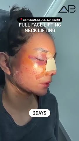 Full face lifting & Neck lifting 8days later! WoW😲 #abplasticsurgery