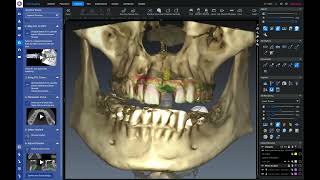 Webinar  Romexis 6   3D Implant Guide