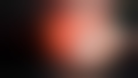 Clamcystoplasty with Mitrofanoff’s on to Umbilicus, M Hussain