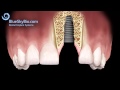 Patient Treatment Videos: Implants