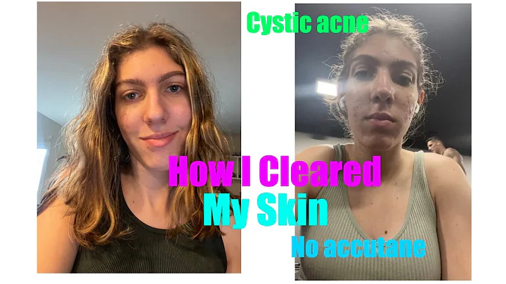 How I cleared my skin| No accutane| simple tips| R...