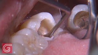 HOW TO Clean Up Severe Occlusal  Decay on TOOTH #31: 1 of 2 screenshot 4