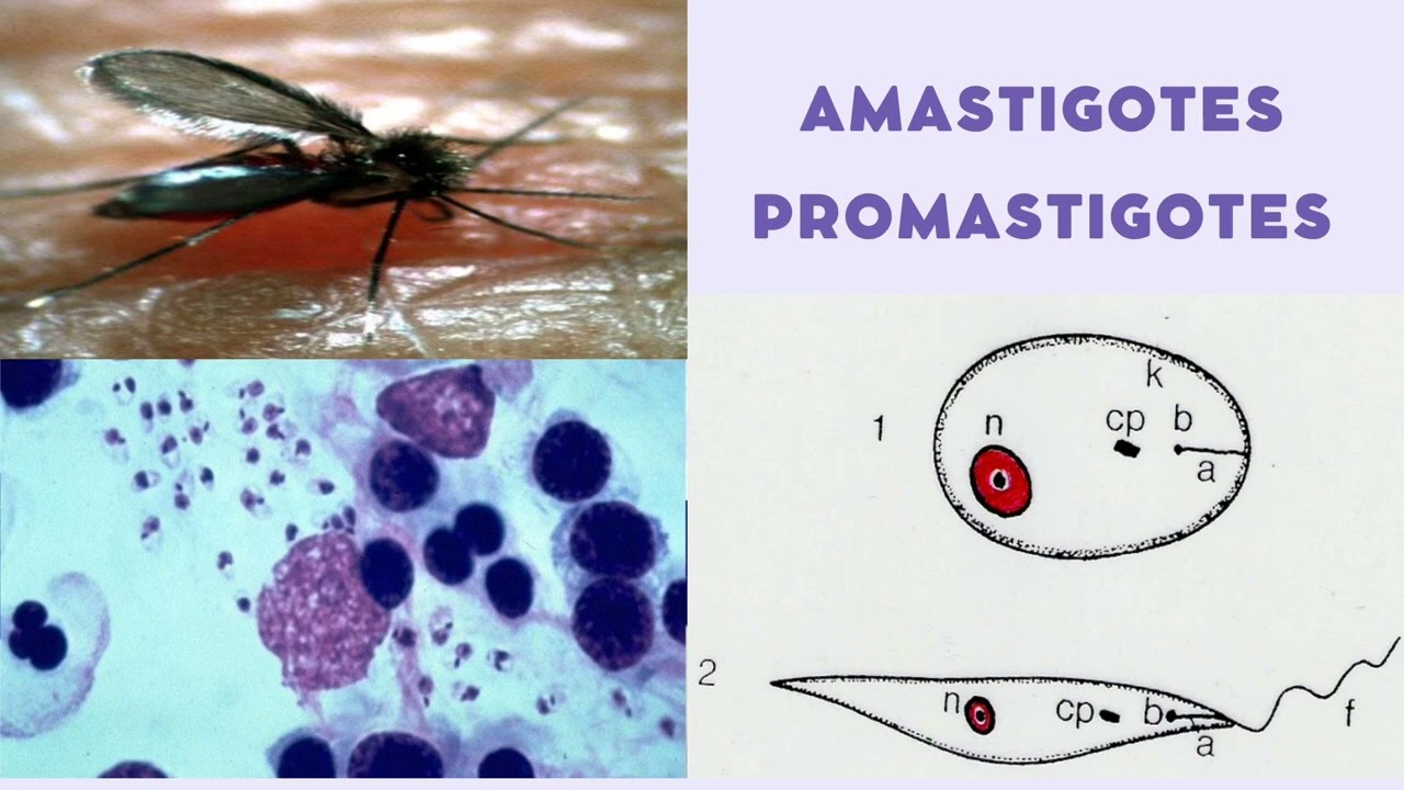 Leishmaniases causes by Leishmania braziliensis