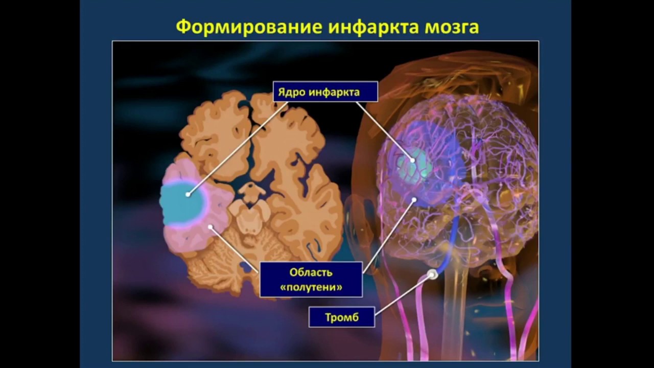 Зона инсульта. Ишемический инсульт (инфаркт мозга). Зоны ишемического инсульта. Формирование инфаркта мозга. Тромболитики при ишемическом инсульте.