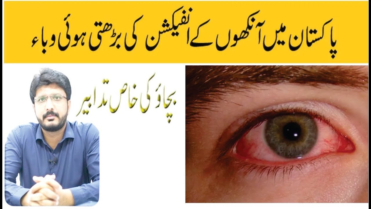 conjunctivitis Pink eyes infection in Pakistan pink eyes infection