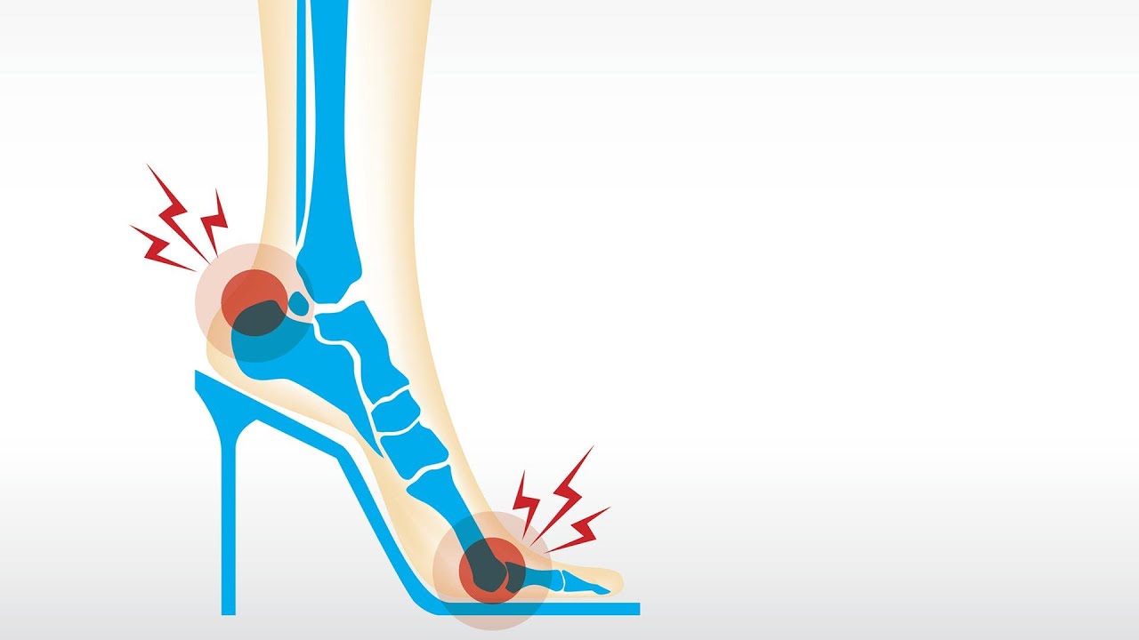 Easy Fixes For High Heel Pain, Arch Pain + Athlete