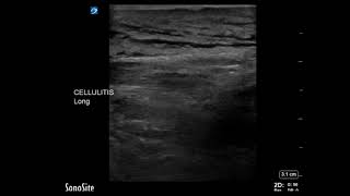 Thigh Ultrasound Cellulitis of the Thigh Long Axis Part 1
