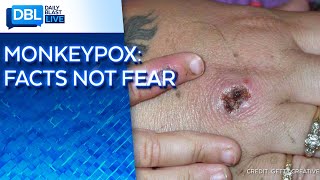 Monkeypox: Symptoms, Treatment & the Real Threat of the Virus