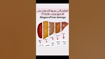 ما هي مراحل التي تدل على ان الكبد مجهد ويجب علاجه كبد Liver Liverhealth Reels Explore اكسبلور 