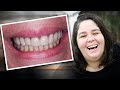 Depoimento Implace Implantes - O Sorriso Natural da Raquel