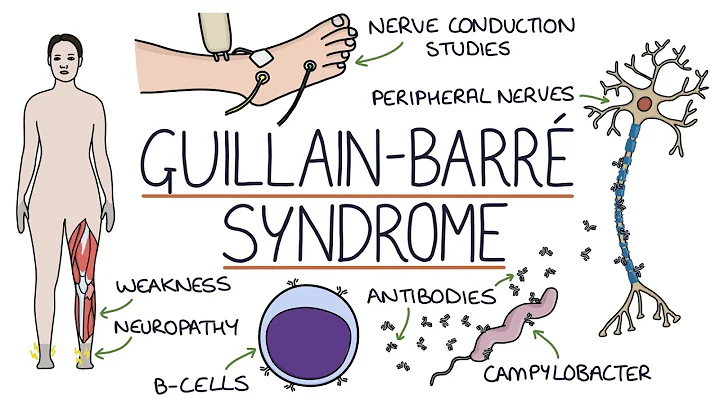 Understanding Guillain-Barré Syndrome