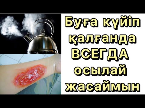 Бейне: Кеш күйік қалай емделеді?