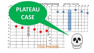11B Unilateral SNHL and the Plateau Method