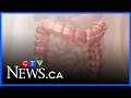 Calls to lower Canada’s colorectal cancer screening