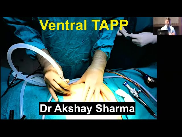 Ventral TAPP