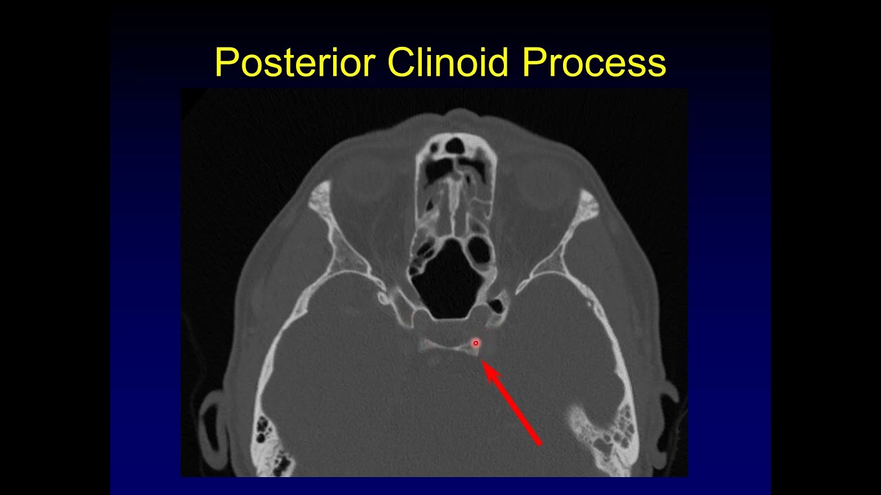 Анатомия основания черепа, часть 1