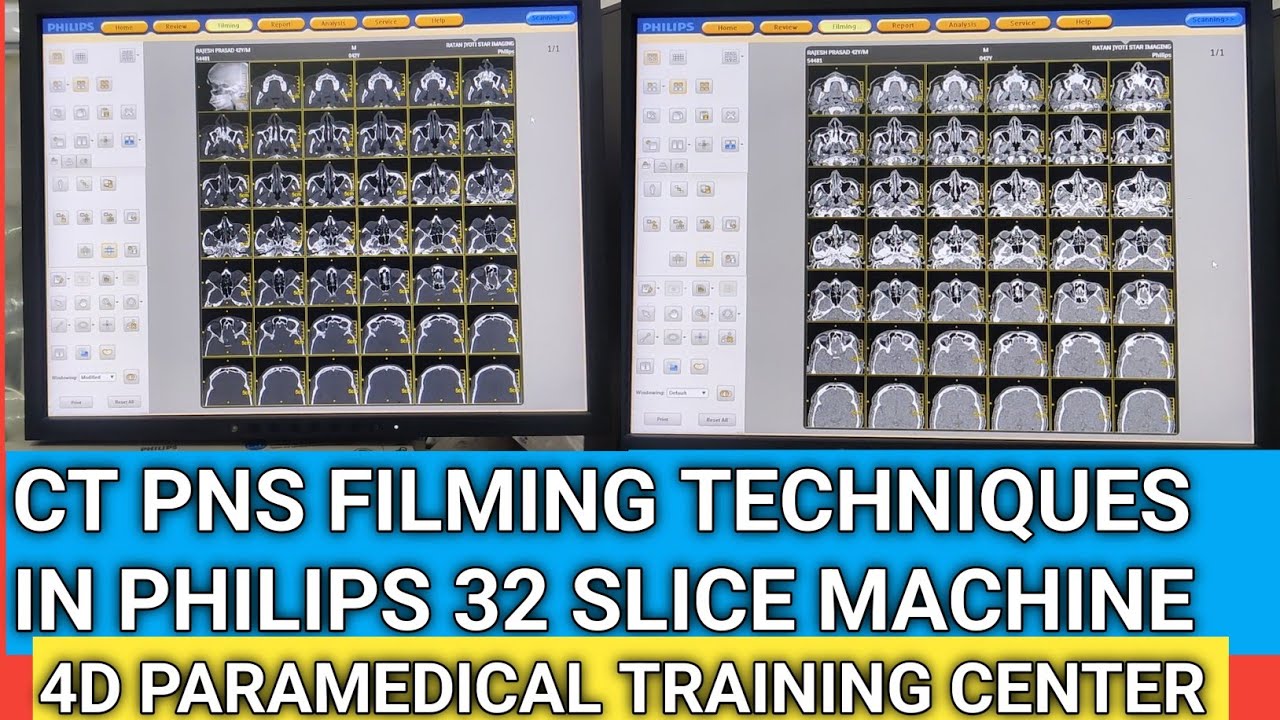 CT PNS FILMING PROCESS IN PHILIPS 32 SLICE MACHINE #philips #ctscan #ct ...