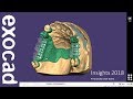 Insights 2018 partialcad case demonstration  bridge with attachments and partial part ii