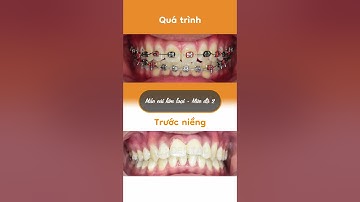 Hành trình LỘT XÁC nhờ niềng răng của Gia Bảo