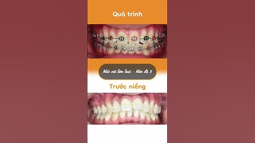 Hành trình LỘT XÁC nhờ niềng răng của Gia Bảo