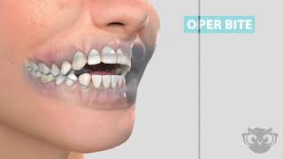 How a habit appliance/tongue crib works
