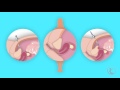 Laparoscopy (In Depth)