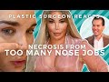 Nose Job Necrosis: How Jessica Alves' Skin Died From Botched Rhinoplasties