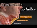 28 yo Male Chin Augmentation & Neck Lift - A Masculine Aesthetic | Aesthetic Minutes #ChinImplant