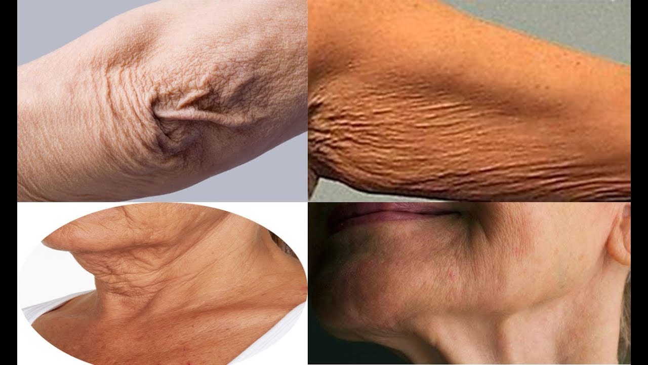 How To Get Rid Of Crepey Skin on Face, Neck, Legs, Upper Arms, Under