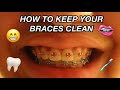 HOW TO CLEAN YOUR BRACES