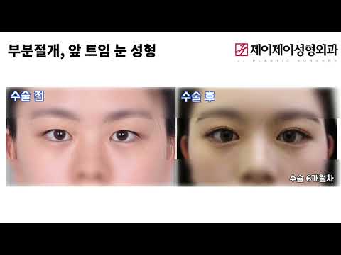 [전후영상] 눈성형 <strong>부분절개</strong>, 앞트임 전후사진 - 제이제이성형외과