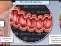 Bowel perforation