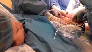 C Section Birth (Breech)