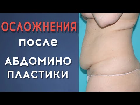 Видео: Панникулэктомия: процедура, выздоровление и осложнения