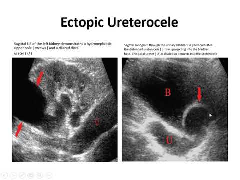 Video: Mucopolysaccharidose Type VI: Casusrapport Met Eerste Neonatale Presentatie Met Ascites Fetalis En Snel Progressieve Cardiale Manifestatie