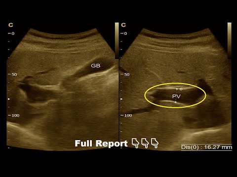 Dilated portal vein ultrasound report and picture | Mild hydronephrosis (LK) | Amader hospital