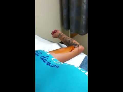 Ala's Nexplanon Birth Control Implant insertion - YouTube