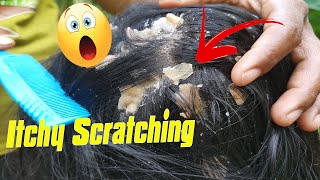 Itchy Dry Scalp and Scratching Treatment - Psoriasis - Dandruff Removal -  Huge Flakes, Part 218