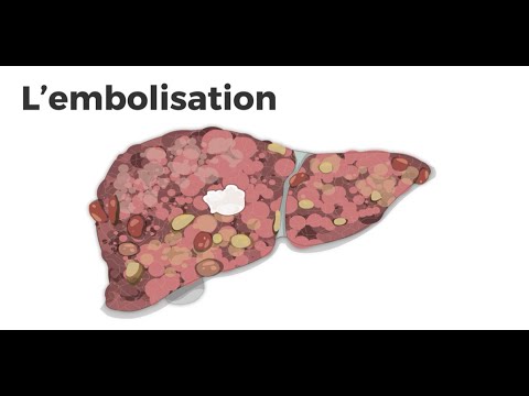 Embolization pour le cancer du foie [crédit : Cirrhosis Care Alberta]