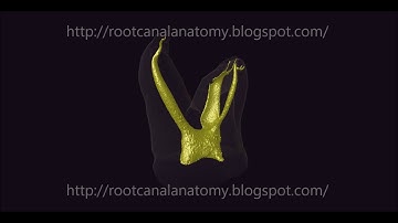 Curved Canals in a Maxillary Molar - Prof. Marco Versiani
