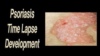 Psoriasis Development Time Lapse from Mild to Severe