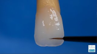 Creating Incisal Edge Effects on Monolithic Veneers and Crown