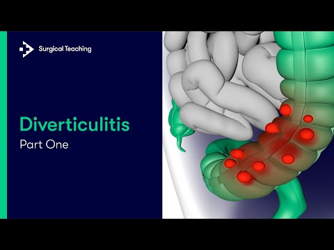 Diverticulitis Part 1 | What is it and What Causes it?