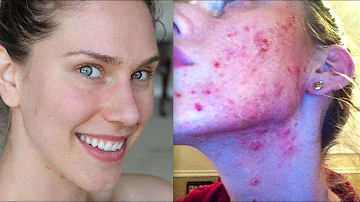 DIET I USED TO CURE MY ACNE AND CLEAR MY SKIN (PART 3)